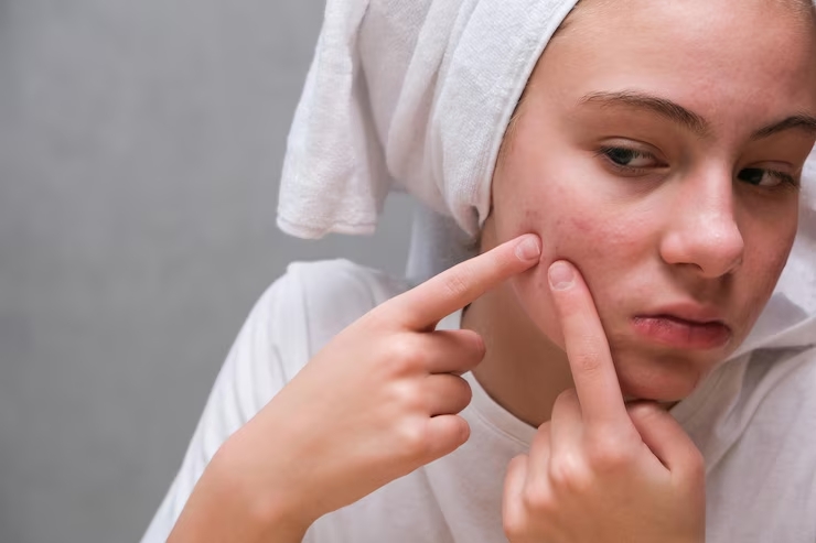 Understanding acne: varieties, origins, and treatments