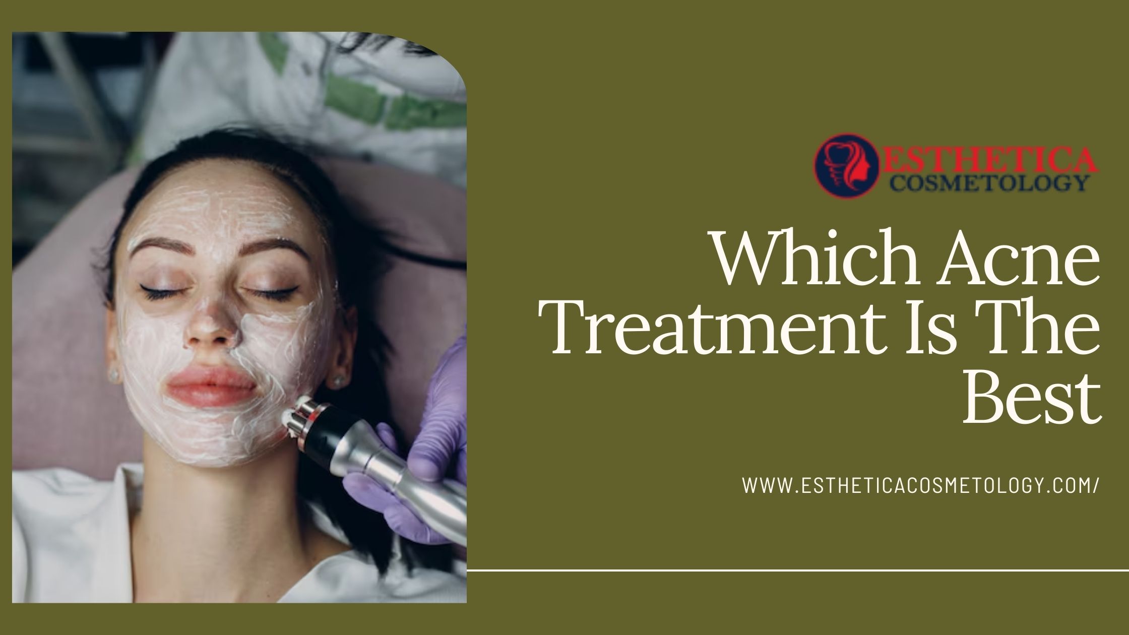 Which Acne Treatment Is The Best?