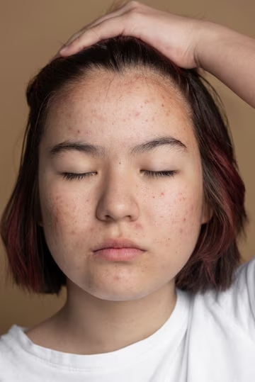 Why Acne In Teens Occurs: Common Causes Explained